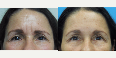 Case 4571 - 55 year old woman treated with Botox