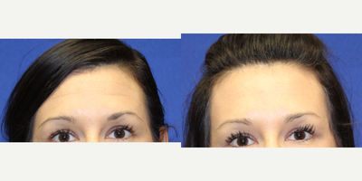 Case 4572 - 32 year old woman treated with Botox to her forhead