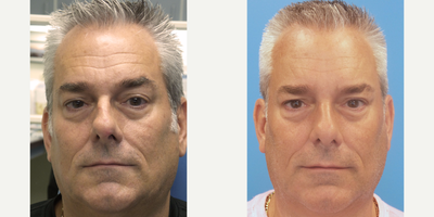 Case 4573 - 52 Year old Male treated with Botox and Restylane