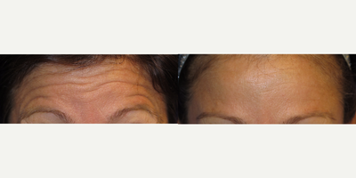 Case 4574 - 38 year old woman treated with Botox