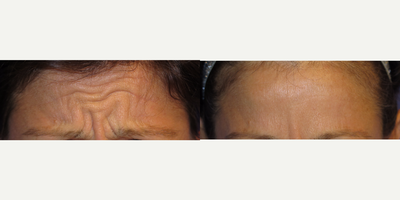 Case 4575 - 38 year old woman treated with Botox