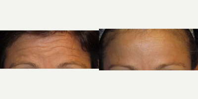 Case 4576 - 38 year old woman treated with Botox