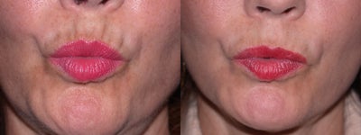 Case 4577 - Before and After Botox to Upper Lip Lines