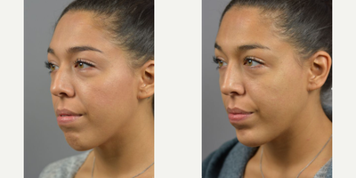 Case 4578 - Woman treated with Nonsurgical Nose Job, Botox, Dermal Fillers