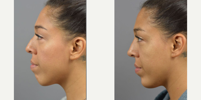 Case 4579 - Woman treated with Nonsurgical Nose Job, Botox, Dermal Fillers