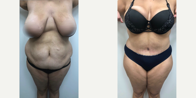 Case 458 - 25-34 year old woman treated with Tummy Tuck