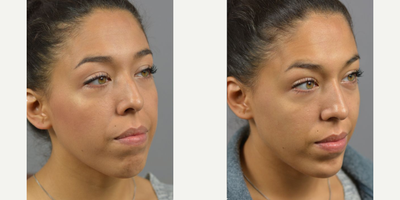 Case 4580 - Woman treated with Nonsurgical Nose Job, Botox, Dermal Fillers