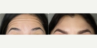 Case 4590 - 25-34 year old woman treated with Botox