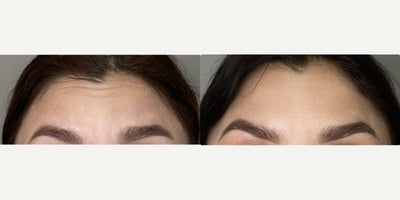 Case 4591 - 25-34 year old gender nonconforming person treated with Botox