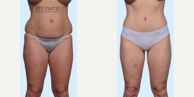 Case 46 - Woman treated with Tummy Tuck