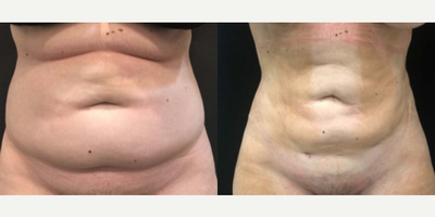 Case 463 - Woman treated with Tummy Tuck