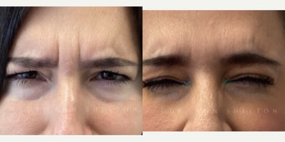 Case 4634 - 35-44 year old woman treated with Botox