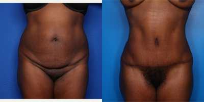 Case 464 - 45-54 year old woman treated with Tummy Tuck