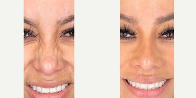 Case 4643 - 35-44 year old woman treated with Botox