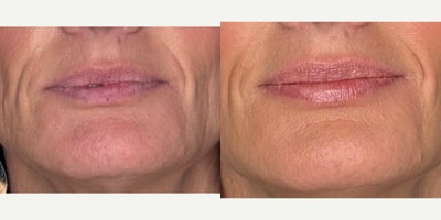 Case 4646 - 35-44 year old woman treated with Botox