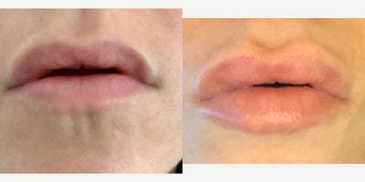 Case 4647 - 25-34 year old woman treated with Botox