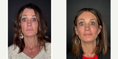 Case 4648 - 35-44 year old woman treated with Botox