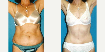 Case 465 - Woman treated with Tummy Tuck