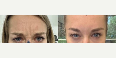 Case 4656 - Woman treated with Botox