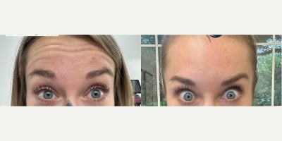 Case 4657 - Woman treated with Botox