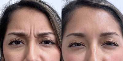 Case 4659 - 29 year old woman treated with Botox