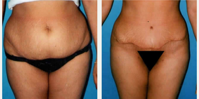 Case 466 - Woman treated with Tummy Tuck