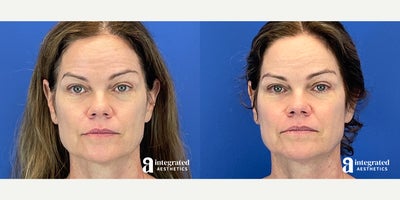 Case 4660 - 45-54 year old woman treated with Botox