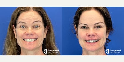 Case 4661 - 45-54 year old woman treated with Botox