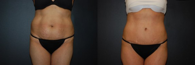 Case 467 - Woman treated with Tummy Tuck