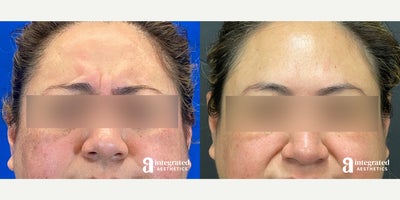 Case 4673 - 35-44 year old woman treated with Botox