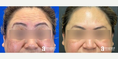 Case 4674 - 35-44 year old woman treated with Botox