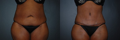 Case 468 - Woman treated with Tummy Tuck