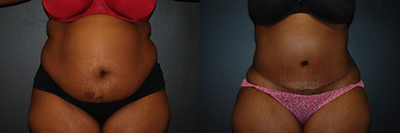 Case 469 - Woman treated with Tummy Tuck