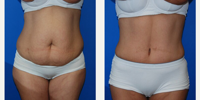 Case 470 - Woman treated with Tummy Tuck