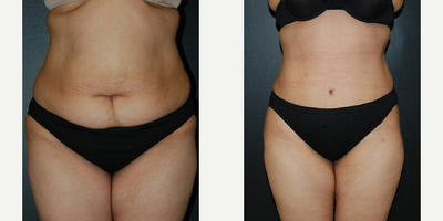 Case 471 - Woman treated with Tummy Tuck