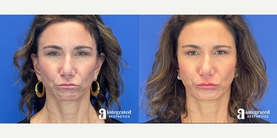 Case 4714 - 45-54 year old woman treated with Botox