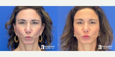 Case 4716 - 45-54 year old woman treated with Botox