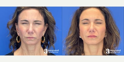 Case 4717 - 45-54 year old woman treated with Botox