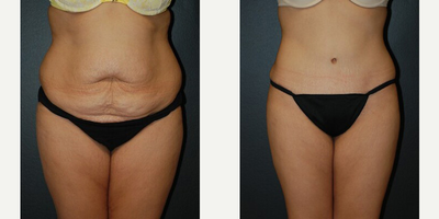 Case 472 - 28 year old woman treated with Tummy Tuck