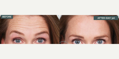 Case 4723 - Woman treated with Botox