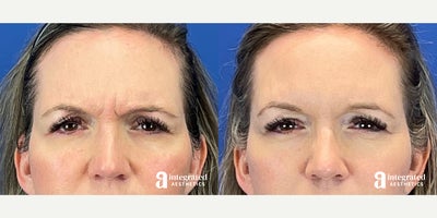 Case 4726 - 45-54 year old woman treated with Botox