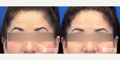 Case 4727 - 45-54 year old woman treated with Botox