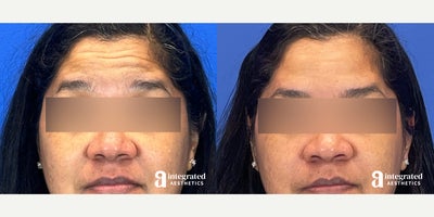 Case 4728 - 45-54 year old woman treated with Botox