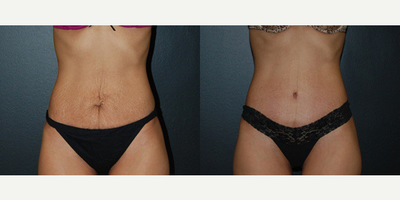 Case 473 - Woman treated with Tummy Tuck
