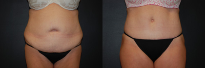 Case 474 - Woman treated with Tummy Tuck