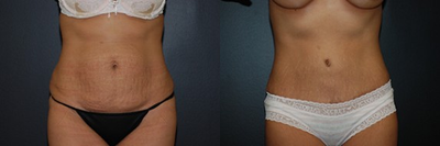 Case 475 - Woman treated with Tummy Tuck