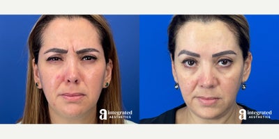 Case 4757 - 45-54 year old woman treated with Botox