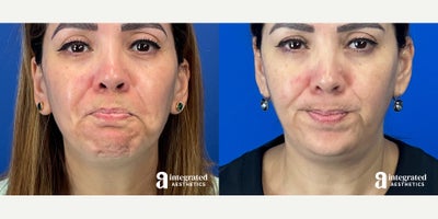 Case 4758 - 45-54 year old woman treated with Botox