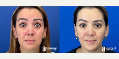 Case 4759 - 45-54 year old woman treated with Botox