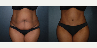 Case 476 - Woman treated with Tummy Tuck